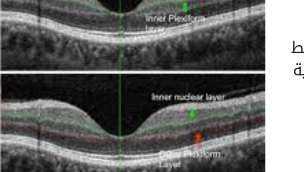 عملية رفع ضغط الأوعية الدموية الدقيقة